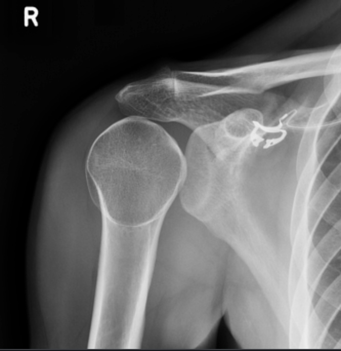 Posterior Shoulder Instability & Dislocation - Shoulder & Elbow ...